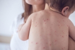 measles in babies, measles vaccination for children, measles back in the united states as children omit vaccination doses, Toddler